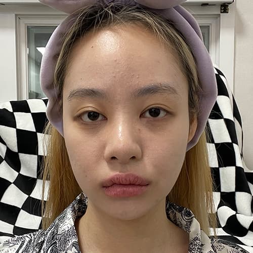 案例 9 術前