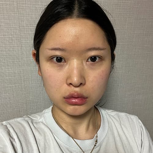 案例 11 術前