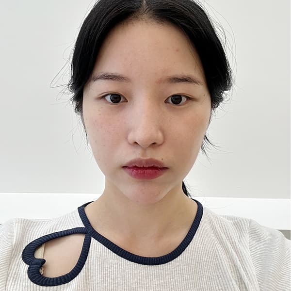 眼整形 術前
