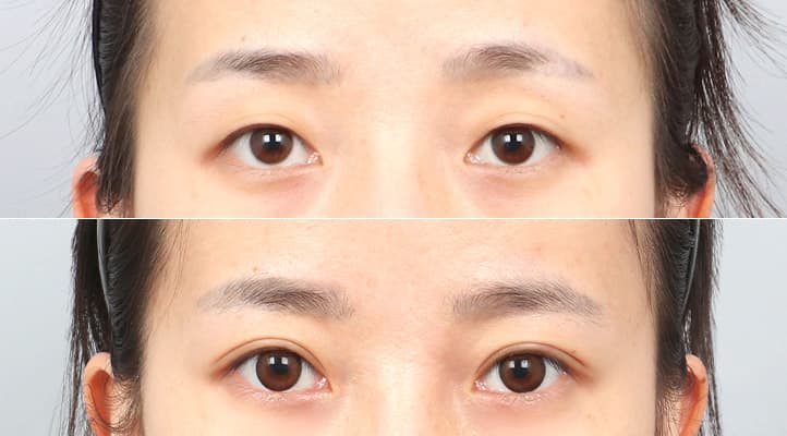 眼整形 術前術後 案例 2