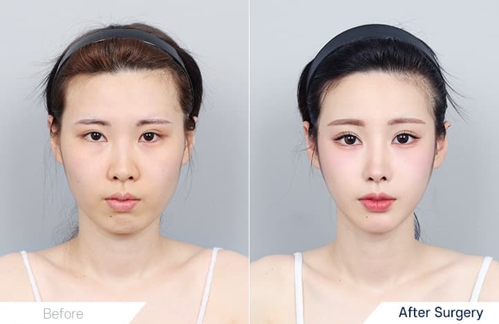 Facial Contour before and after