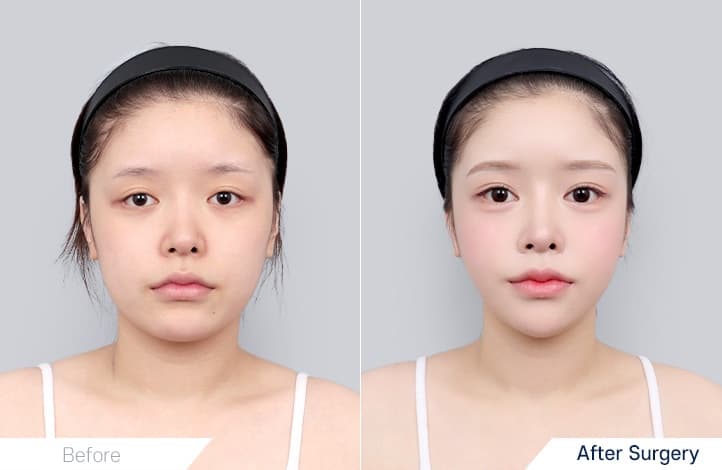 Facial Contour before and after