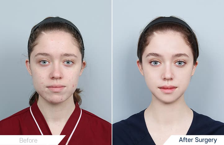 Facial Contour before and after