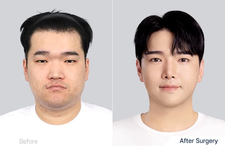 Facial Contour before and after