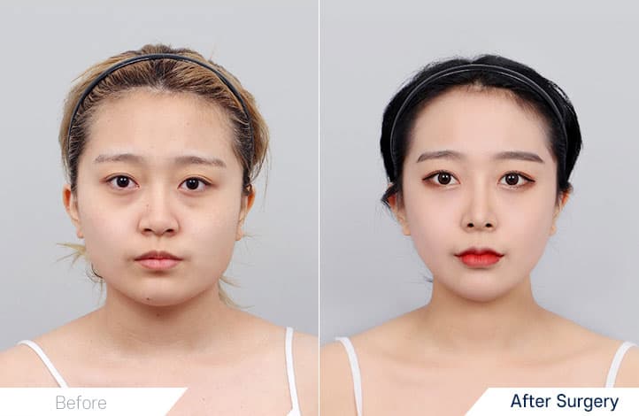 Facial Contour before and after