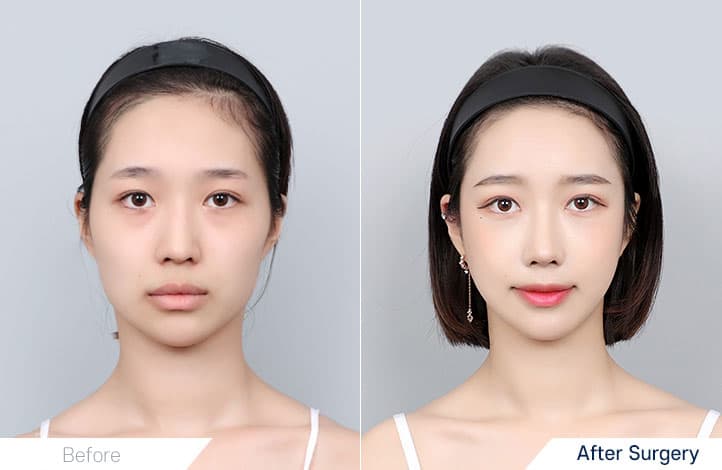 Facial Contour before and after