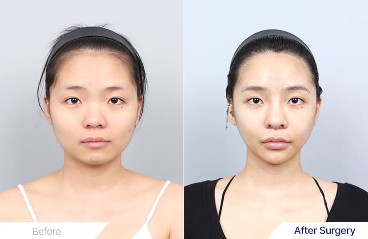 Facial Contour before and after
