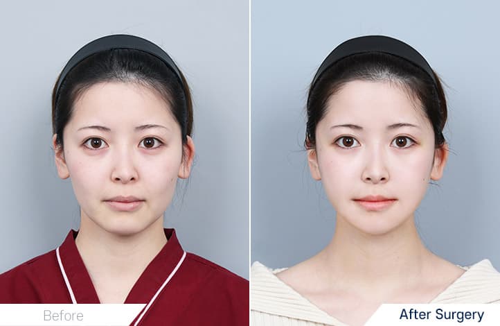 輪郭3点, アキュースカルフリフティング