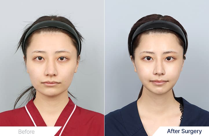輪郭手術