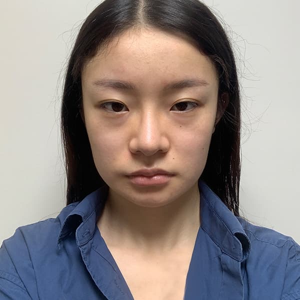 実際のお客様の術後セルフィー 2