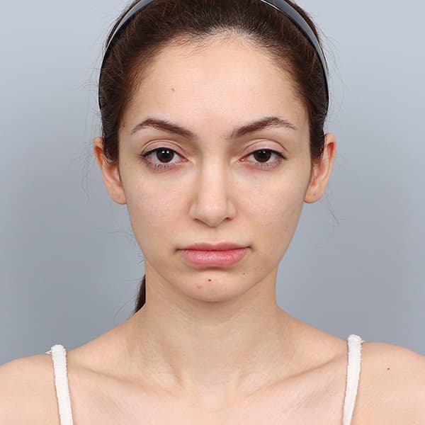 実際のお客様の術後セルフィー 2