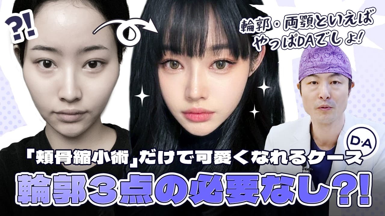 ［韓国整形］輪郭3点の必要なし？！頬骨手術だけで十分なケースとは？［DA美容外科］