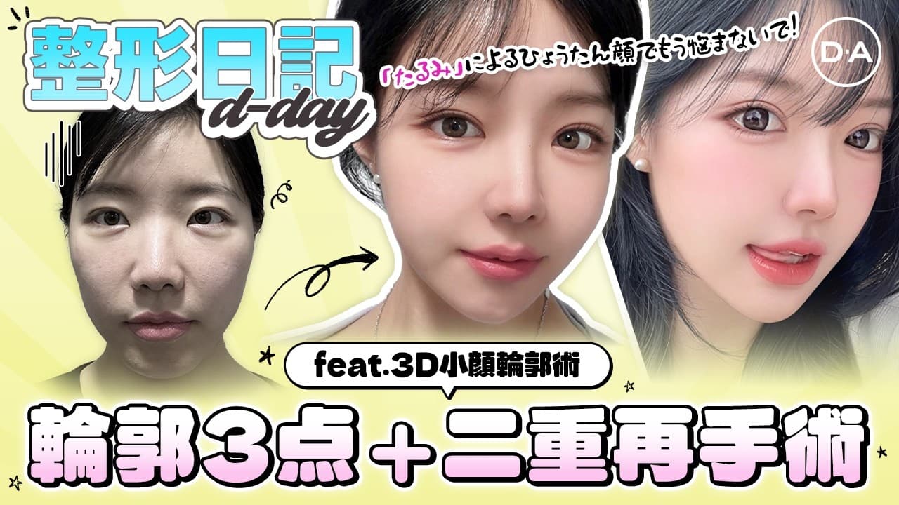 ［韓国整形］輪郭3点＋３D小顔輪郭術＋二重再手術でこんなに変わったよ！ダウンタイムを大公開！［DA美容外科］