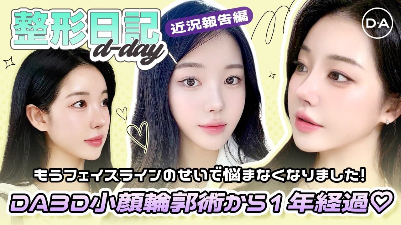 ［韓国整形］近況報告！DA3D小顔輪郭術から1年が経ちました♡［DA美容外科］