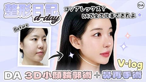 [韓国整形］コンプレックスはDAに全てお任せしちゃおう！DA3D小顔輪郭術＋鼻再手術V LOG［DA美容外科］
