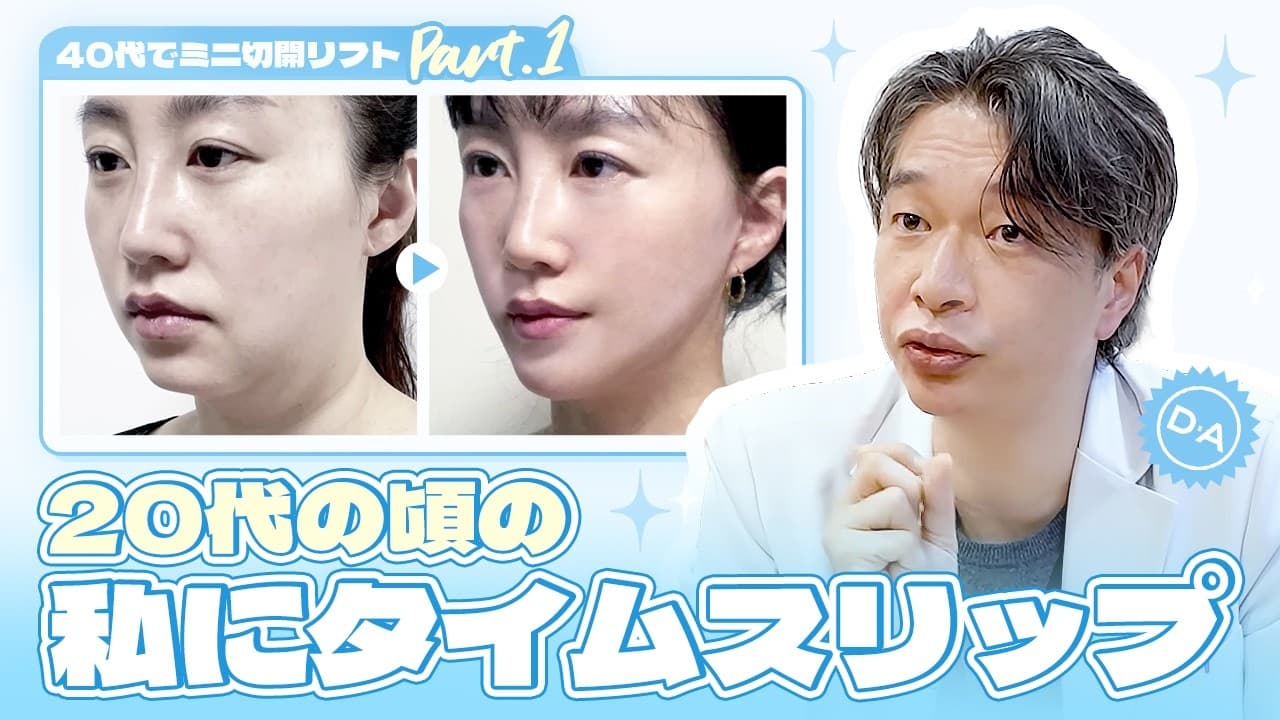 ［韓国整形］20代の頃の私にタイムスリップ♪ 40代でミニ切開リフトPart 1［DA美容外科］