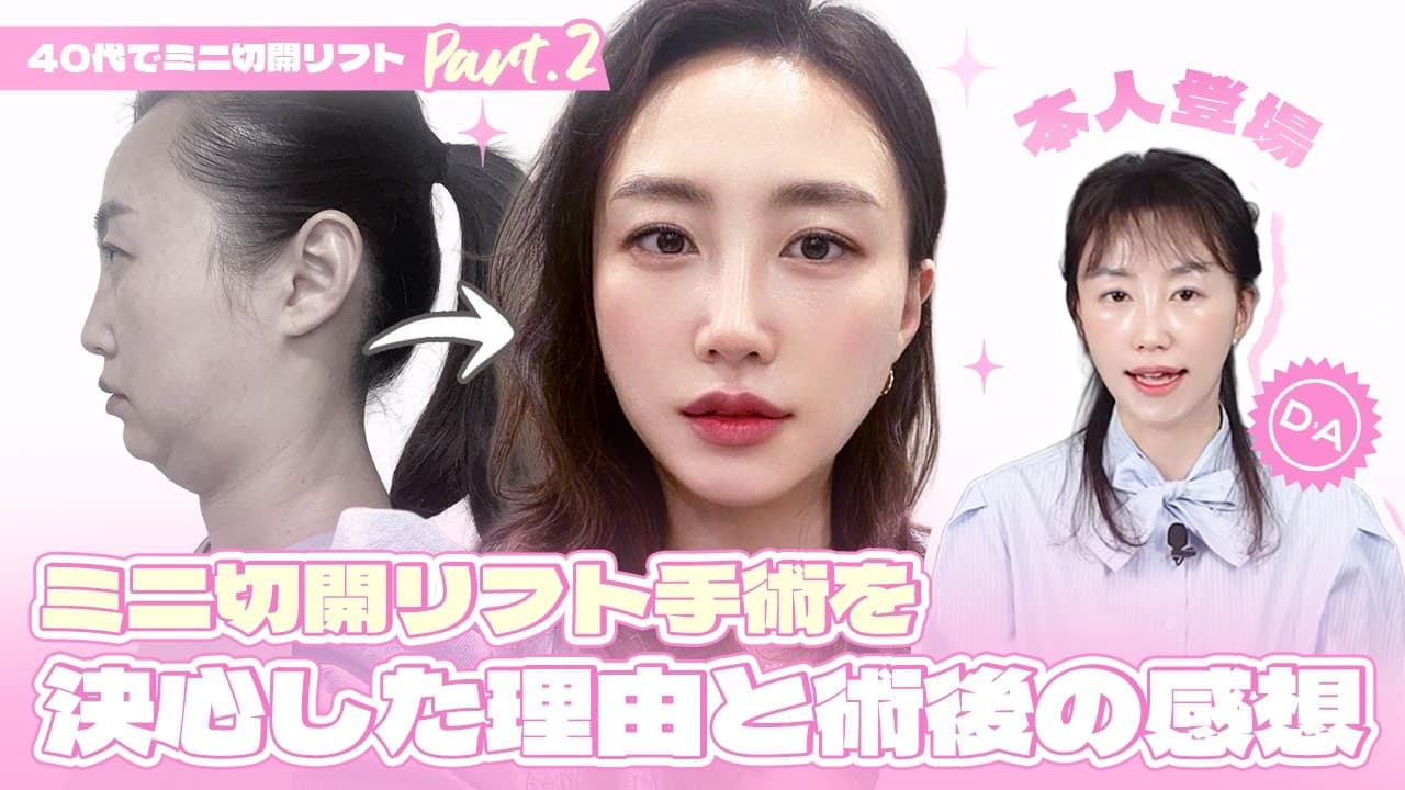 ［韓国整形］本人登場！DAミニリフトの感想♪ 40代でミニ切開リフトPart 2［DA美容外科］