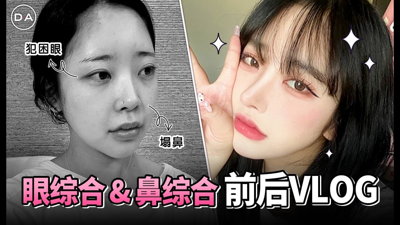 【韓國DA整形】整形vlog——眼整形 & 鼻整形 DA小姐姐 前後對比VLOG！！