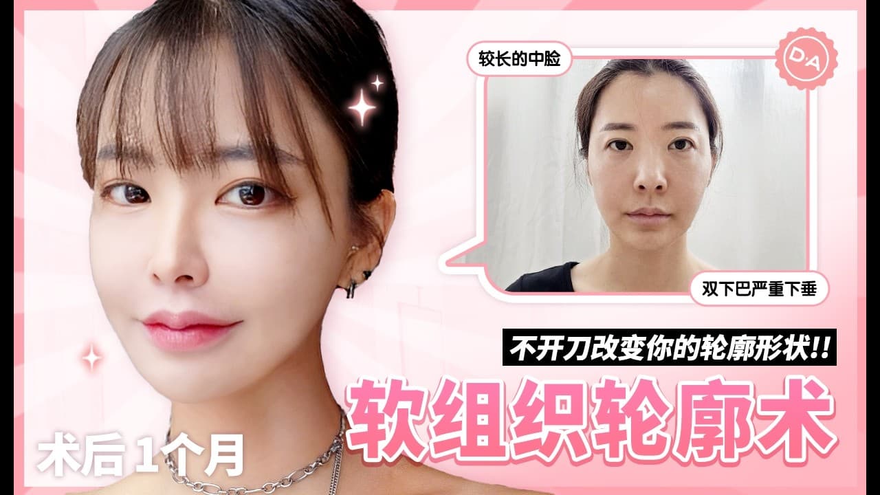 【韓國DA整形】術後1個月，軟組织輪廓術！_不開刀改變你的輪廓形状