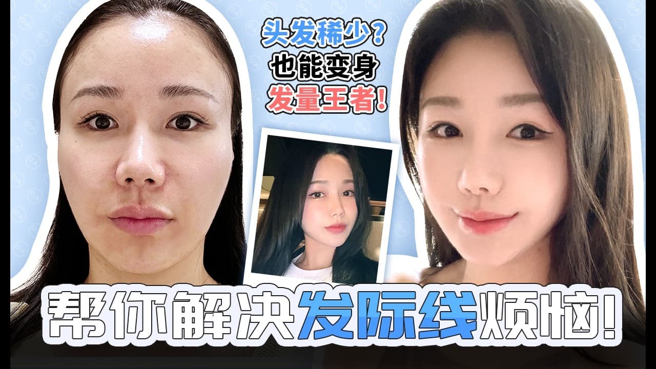 [韓國DA整形] 帮你解决髮際線的一切烦恼！！