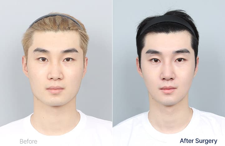 面部輪廓・雙顎 術前術後