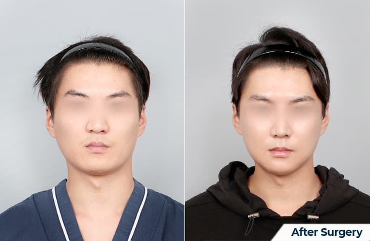 面部輪廓・雙顎 術前術後