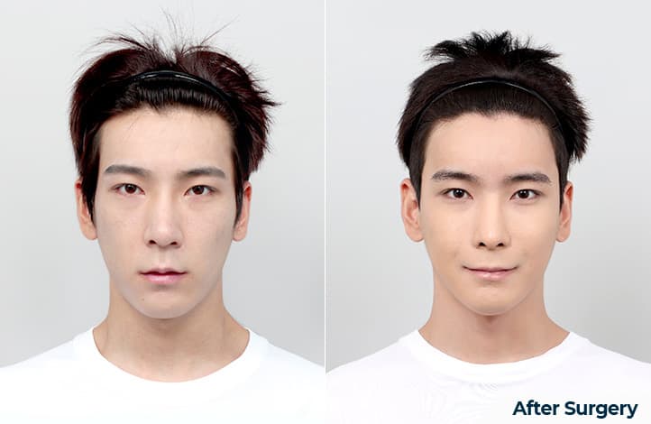 面部輪廓・雙顎 術前術後