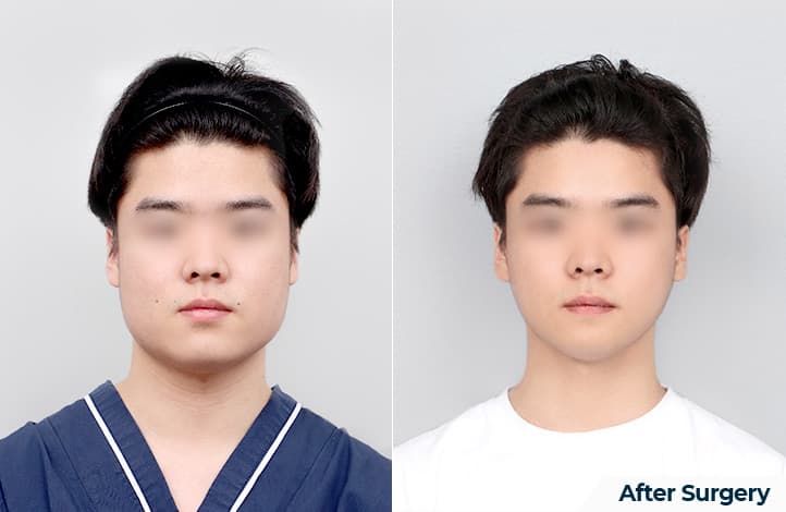 面部輪廓・雙顎 術前術後