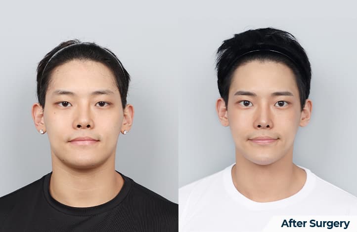 面部輪廓・雙顎 術前術後