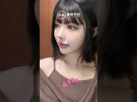 ［韓国整形］DA鼻整形でここまで可愛くなれた🩷［DA美容外科］