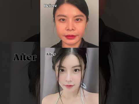 ［韓国整形］切開リフトでここまで美しく🥹💜［DA美容外科
