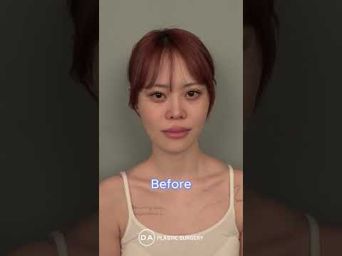 ［韓国整形］両顎・輪郭手術レイちゃんBeforeAfter🩷🩷［DA美容外科