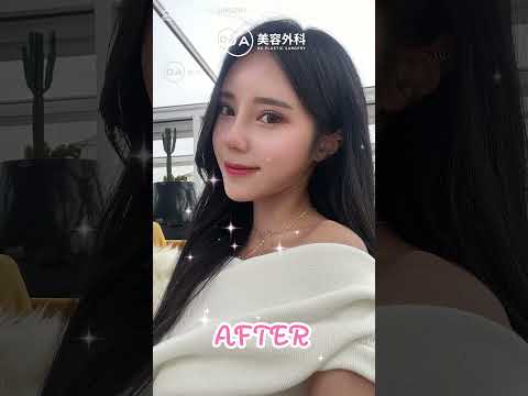 ［韓国整形］鼻整形ビフォーアフター✨［DA美容外科］