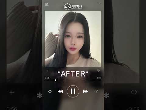 ［韓国整形］輪郭手術と鼻整形も同時手術が可能✨［DA美容外科