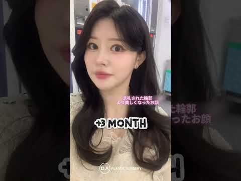 ［韓国整形］輪郭手術ならda🥰［DA美容外科］