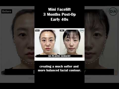 미니 안면거상술 전후 비교 | 수술 3개월 차 | 40대 초반