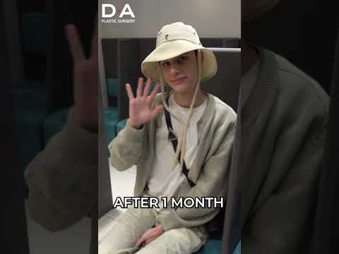 제임스의 DA 성형외과 코 수술 후기