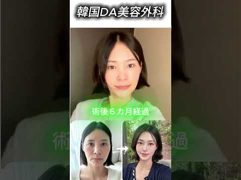 ［韓国整形］輪郭手術とリフティング手術は同時に可能なのがDA🥹🩷［DA美容外科］