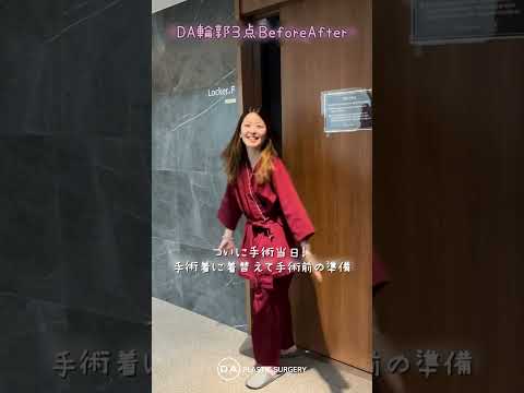 ［韓国整形］輪郭3点日本人ビフォーアフター✨［DA美容外科］