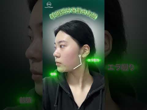 ［韓国整形］輪郭手術ならやっぱりDAでしょ🥹🩷［DA美容外科］